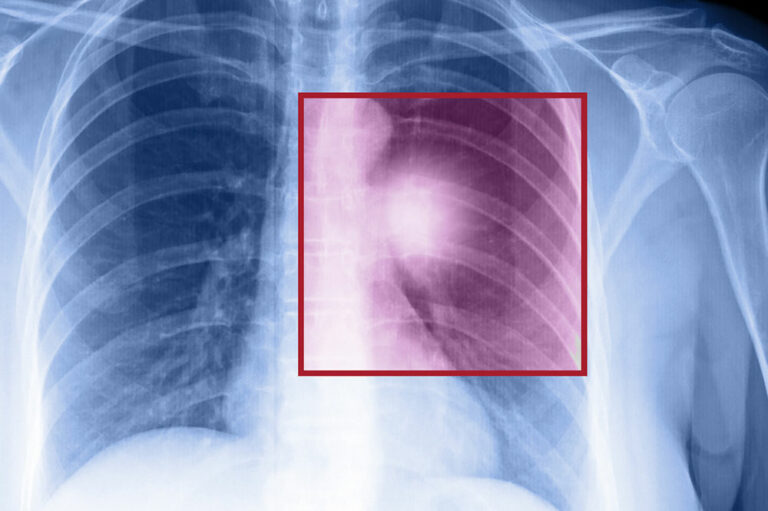 Lung cancer – Types, symptoms, and causes